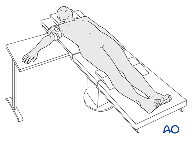 Supine patient positioning and portal designation. (A) Supine position