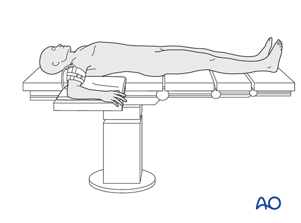 Supine patient positioning and portal designation. (A) Supine position