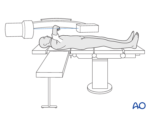 The C-arm can be brought in from the opposite side of the table in a horizontal orientation. Lateral views are obtained by lifting the elbow into the x-ray beam, and AP views are obtained by rotating the shoulder.