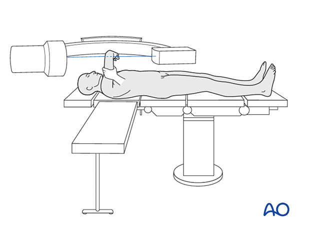 Supine patient positioning and portal designation. (A) Supine position