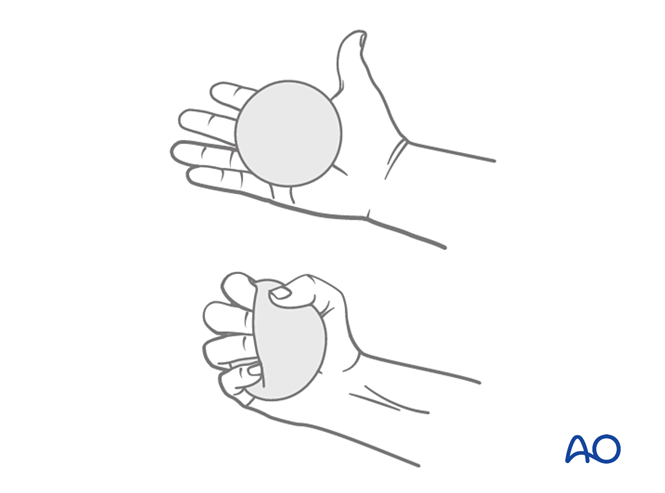 ORIF - Plate fixation for Complete articular fracture, simple articular ...