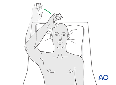 ORIF - Headless screw fixation for Partial articular fracture in ...