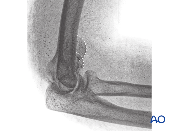 X-ray image showing the double-arc sign indicating a coronal fracture involving capitellum and trochlea