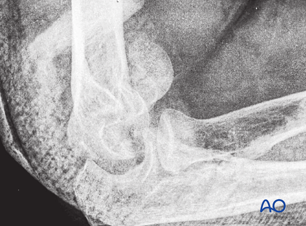 X-ray image of the elbow in a cast