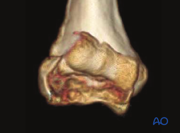 3-D CT reconstruction of capitellar and trochlear fracture