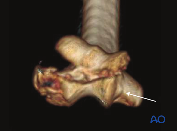 3-D CT reconstruction of a complex coronal fracture of capitellum and trochlea, involving a lateral epicondylar fracture, posterior impaction, and medial fracture extension