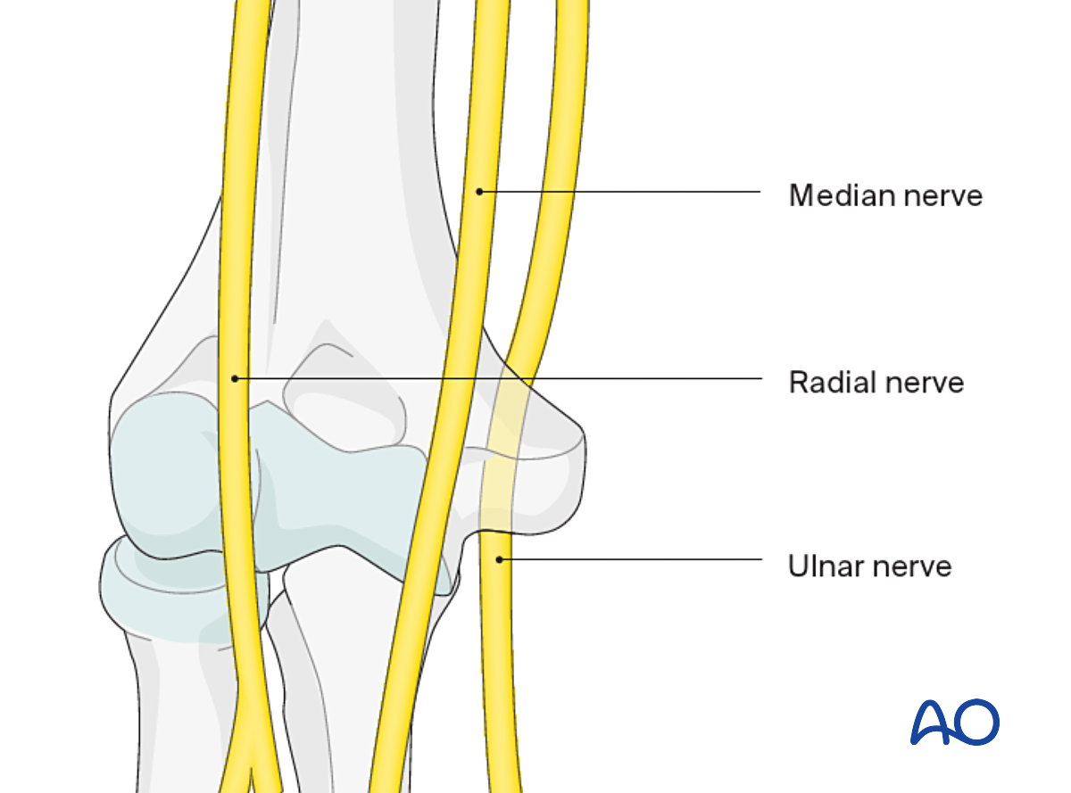 Splint Immobilization For Extraarticular, Simple Oblique Fracture