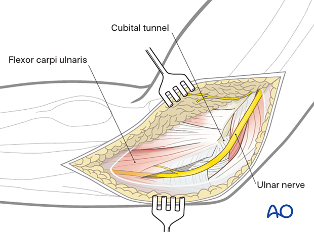 Ulnar nerve with the medial intermuscular septum incised