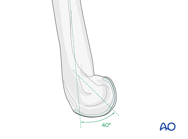 The articular block of the distal humerus is anteriorly angled by about 40° with respect to the humeral shaft axis.