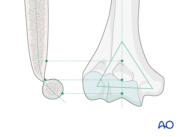 The articular block and both columns form an asymmetric triangle, which is the base for the stability of the distal humerus.