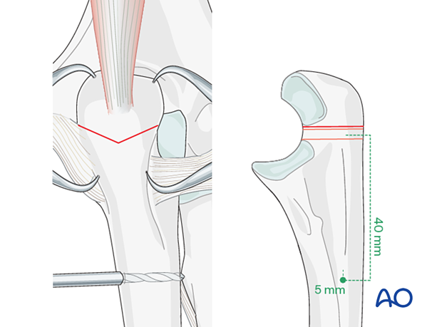 Approximately 40 mm distal to the fracture line and at least 5 mm from the posterior cortex, drill a hole through the ulna with a 2.0 mm drill.