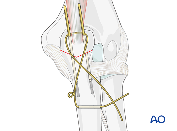 Pass the long segment of the wire in a figure-of-eight configuration beneath the triceps tendon around the protruding ends of the K-wires.