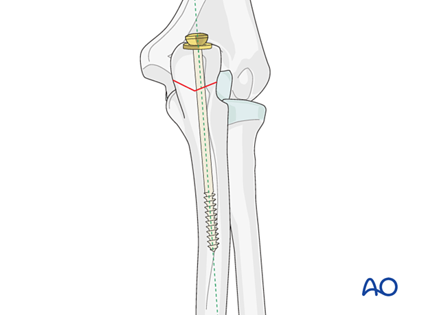 The entry point of the screw should be offset from the center of the olecranon tip to account for the varus bow and prevent gapping at the osteotomy site.