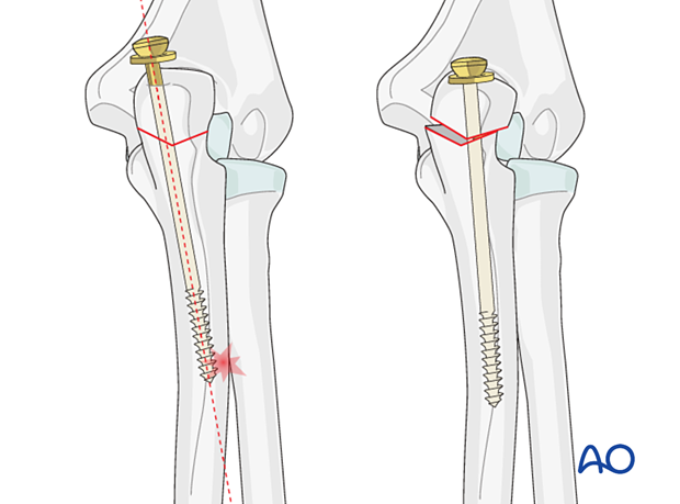 Incorrect entry point and screw angle will lead to premature engagement of the screw tip with the ulna cortex. This leads to gapping of the osteotomy as the screw is driven distally.