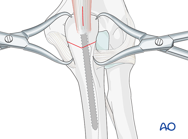 Reduce and hold the osteotomy with pointed reduction forceps to apply compression.