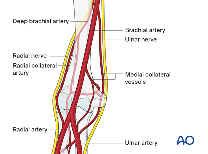 ORIF - Plate fixation for Complete articular fracture, simple articular ...