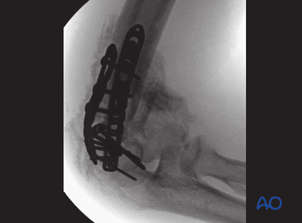 X-ray showing heterotopic ossification around the elbow after plate fixation of a distal humeral fracture