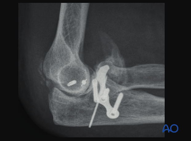 X-ray image of the elbow showing heterotopic ossification