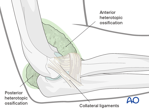 Heterotopic ossification around the elbow
