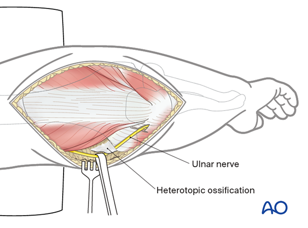 Heterotopic ossification around the ulnar nerve
