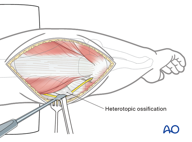 Heterotopic ossification around the ulnar nerve