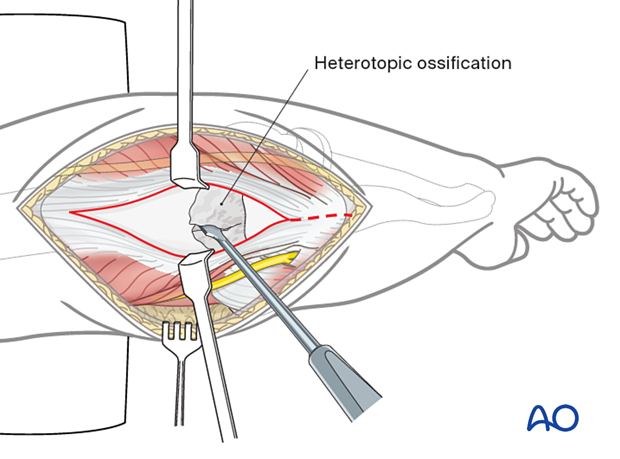 Heterotopic ossification in the olecranon fossa