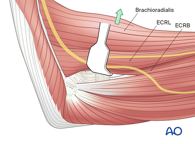 Elevation of the extensor carpi radialis longus and brevis of the humerus, along with brachioradialis, are elevated.