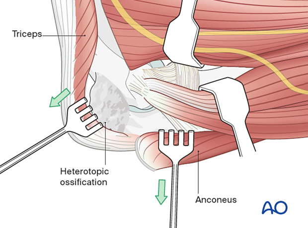 The triceps and anconeus are elevated off of the distal humerus and ulna