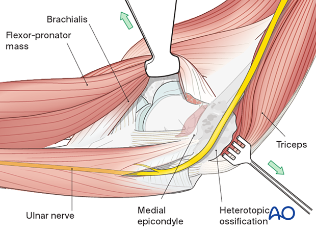The over-the-top approach elevates the brachialis muscle off the distal humerus along with the anterior half of the flexor-pronator mass that is divided horizontally.
