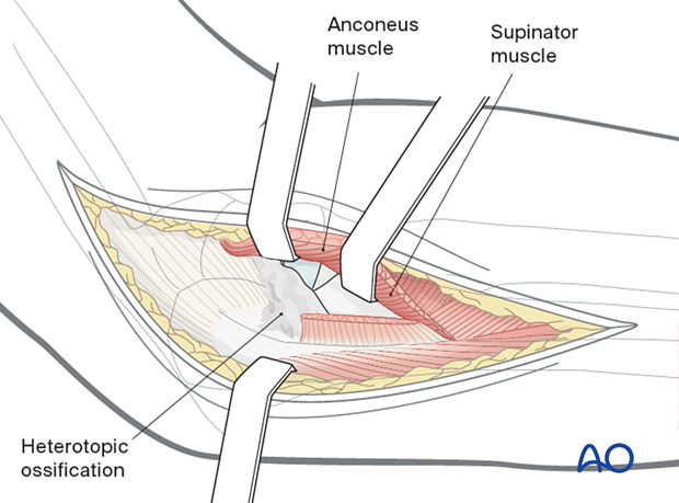 Heterotopic bone between the radius and ulna