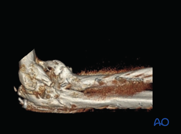 3-D CT imaging of the elbow showing heterotopic ossification