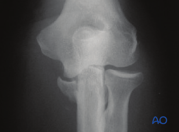 Radiocapitellar gapping due to fracture of the coronoid allowing associated ulnohumeral subluxation