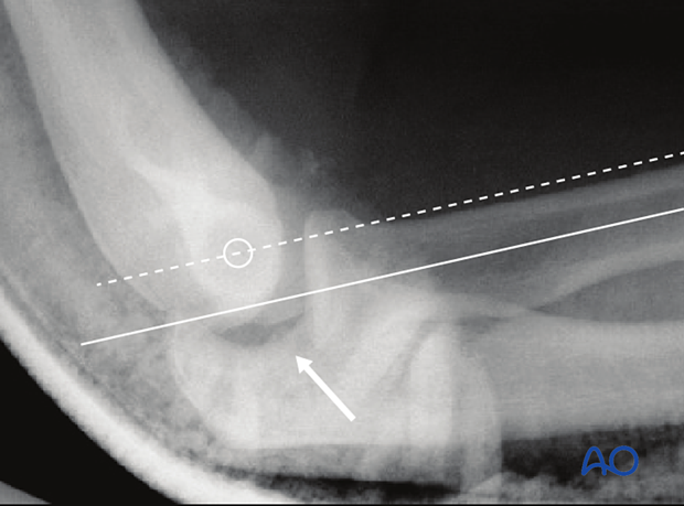 On a lateral x-ray, a line bisecting the radial shaft may not pass through the middle of the capitellum, and there may also be a slight gap or “drop sign” in the ulnohumeral joint.