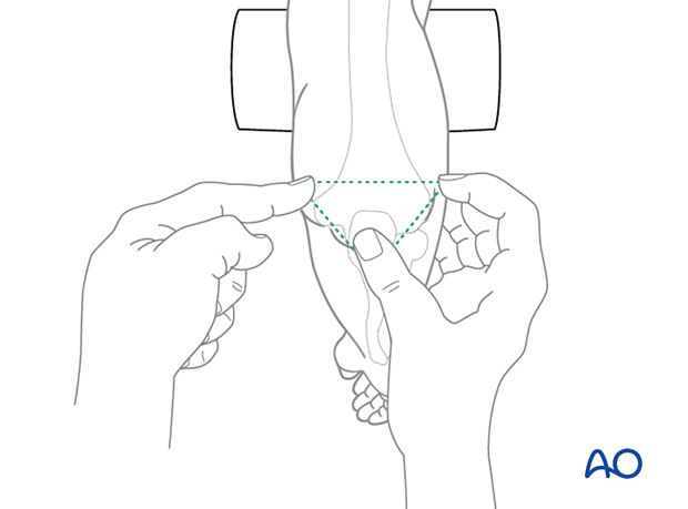 The medial and lateral epicondyles and the tip of the olecranon should form a triangle in the plane parallel to the shaft of the humerus with the elbow flexed.