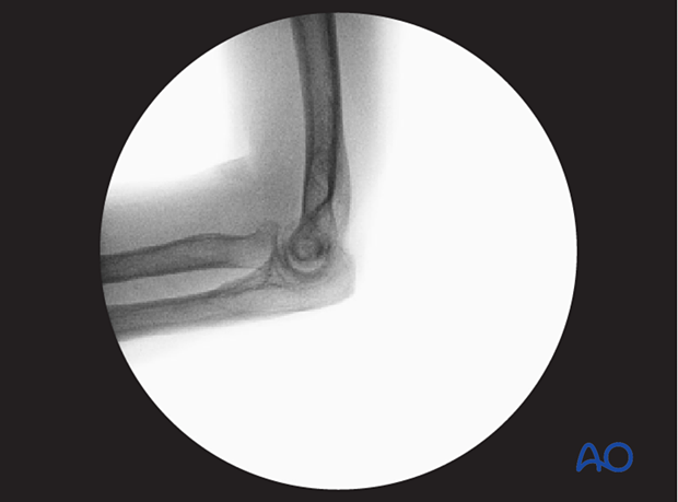 Optimal lateral view of distal humerus