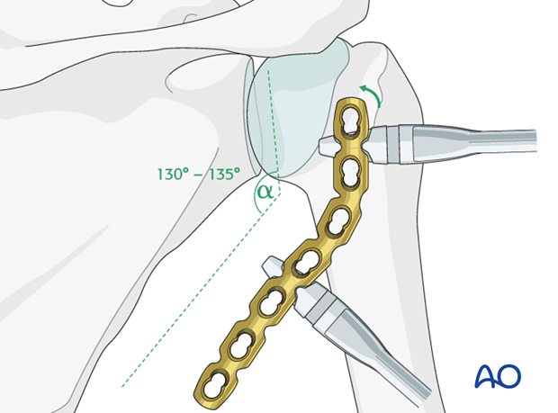 orif plate fixation