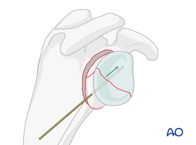 ORIF - Plate fixation for Glenoid fossa, complete articular, articular ...