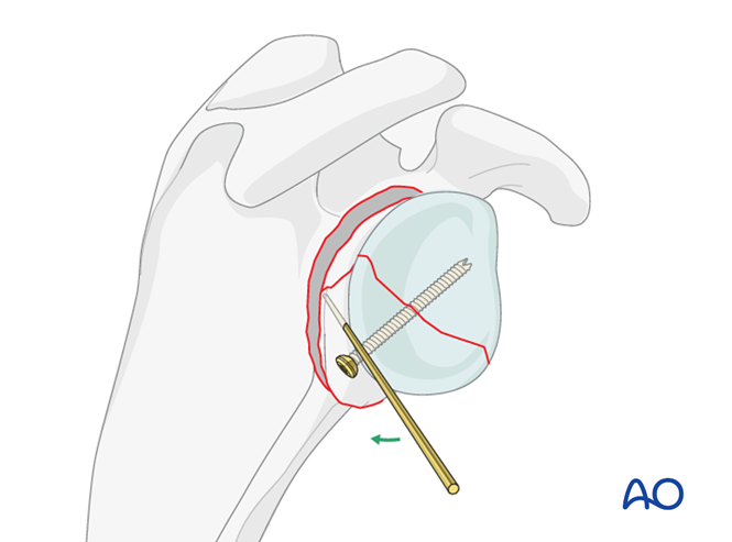 ORIF - Plate fixation for Glenoid fossa, complete articular, articular ...