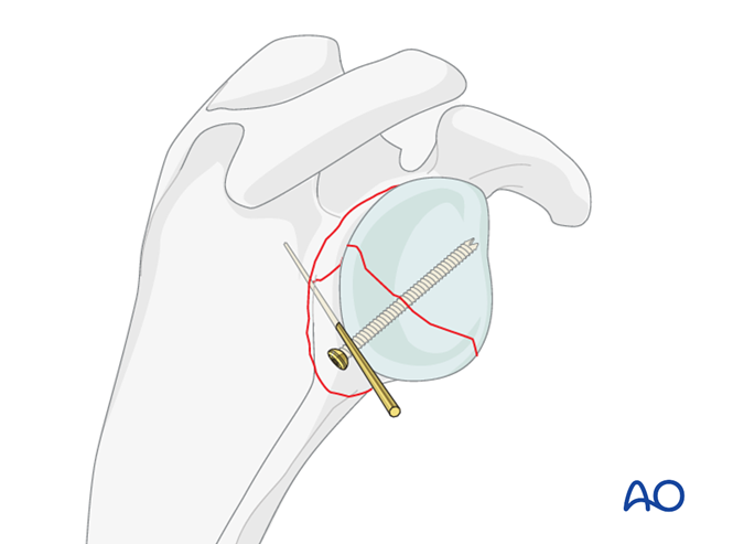 ORIF - Plate fixation for Glenoid fossa, complete articular, articular ...