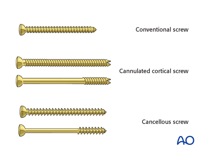 ORIF - Lag screw fixation for Glenoid fossa, partial articular ...