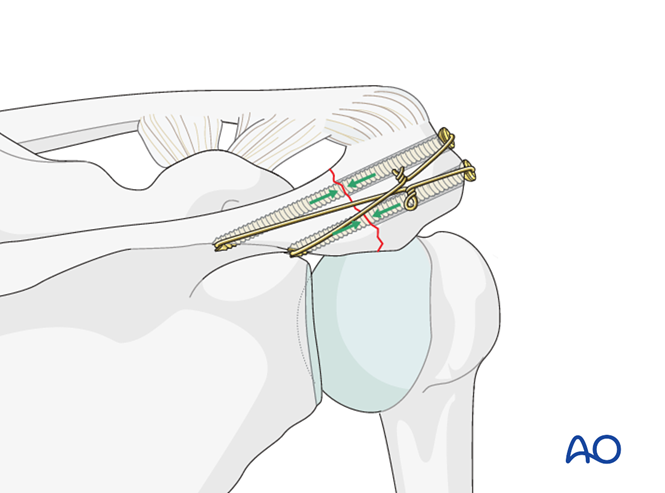 ORIF - Lag screw fixation for Body and processes, acromion