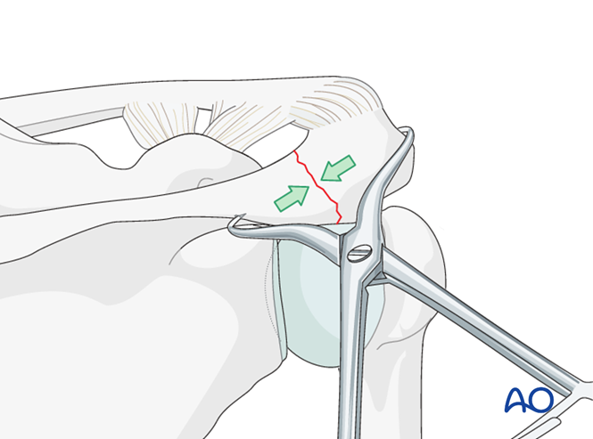 ORIF - Lag screw fixation for Body and processes, acromion