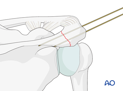 ORIF - Lag screw fixation for Body and processes, acromion