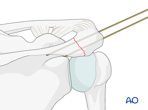 Guide wire insertion/Temporary fixation