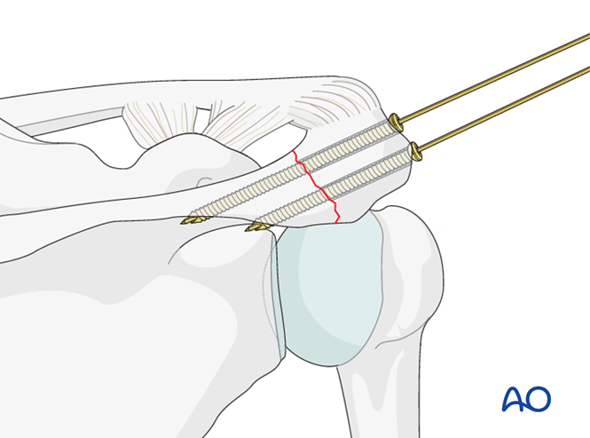 ORIF - Lag screw fixation for Body and processes, acromion