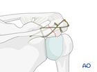 body and processes acromion
