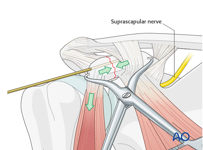 ORIF - Lag screw fixation for Body and processes, coracoid