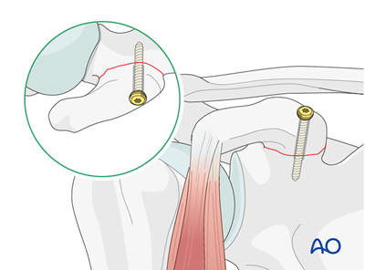 ORIF - Lag screw fixation for Body and processes, coracoid