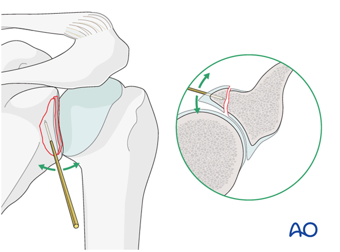 ORIF - Lag screw fixation for Glenoid fossa, partial articular ...