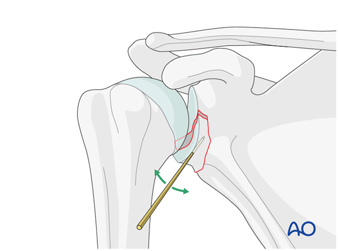 ORIF - Lag screw fixation for Glenoid fossa, partial articular ...